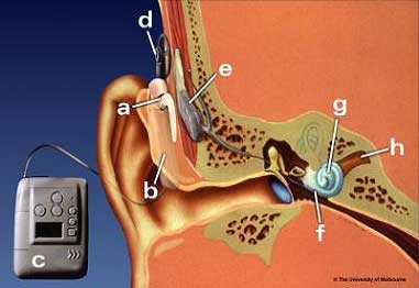 Cochlear Implant Diagram